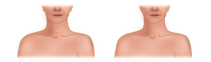 Удаление рубцов