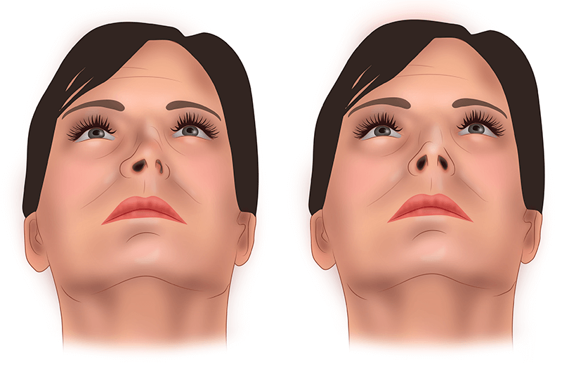 Септопластика