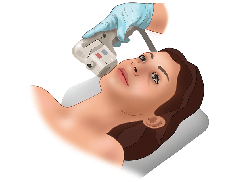 СМАС-лифтинг