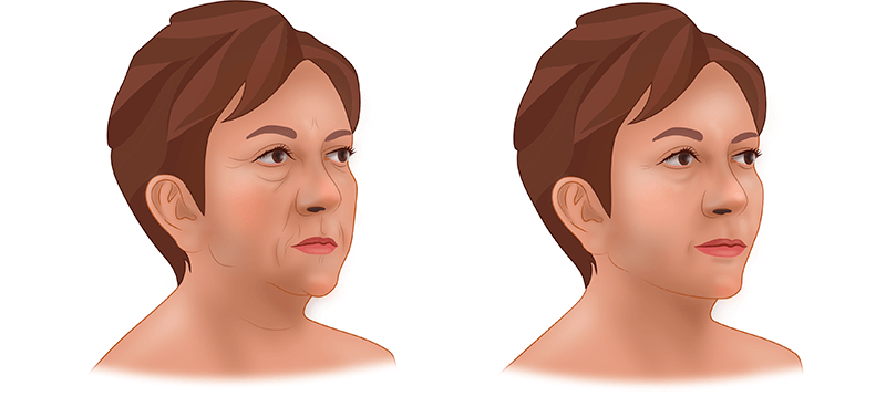 Спейслифтинг