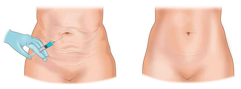 Мезотерапия живота
