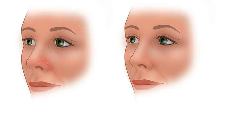 Удаление сосудистых звездочек