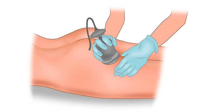 Ультразвуковая липосакция