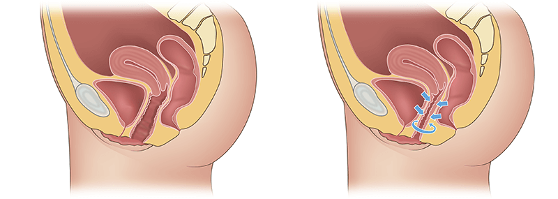 Вагинопластика